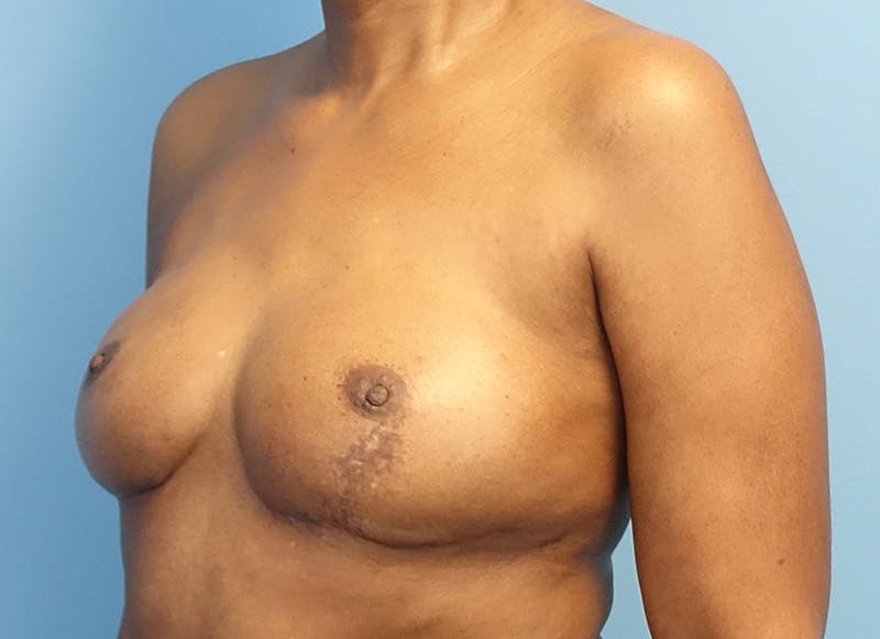 Flap Reconstruction Gallery Before & After Gallery - Patient 845593 - Image 4