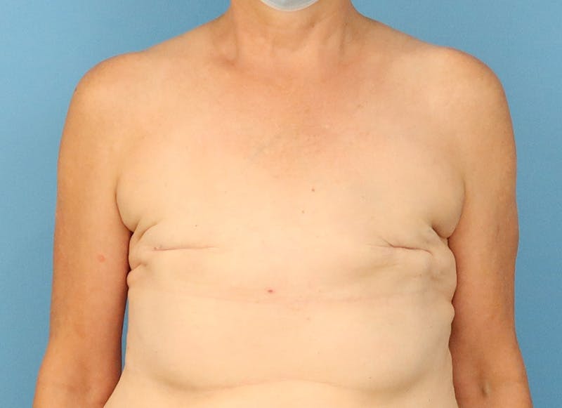 Flap Reconstruction Gallery Before & After Gallery - Patient 255284 - Image 5