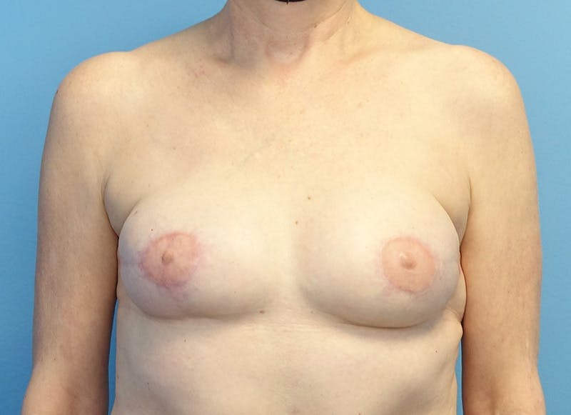 Flap Reconstruction Gallery Before & After Gallery - Patient 255284 - Image 6