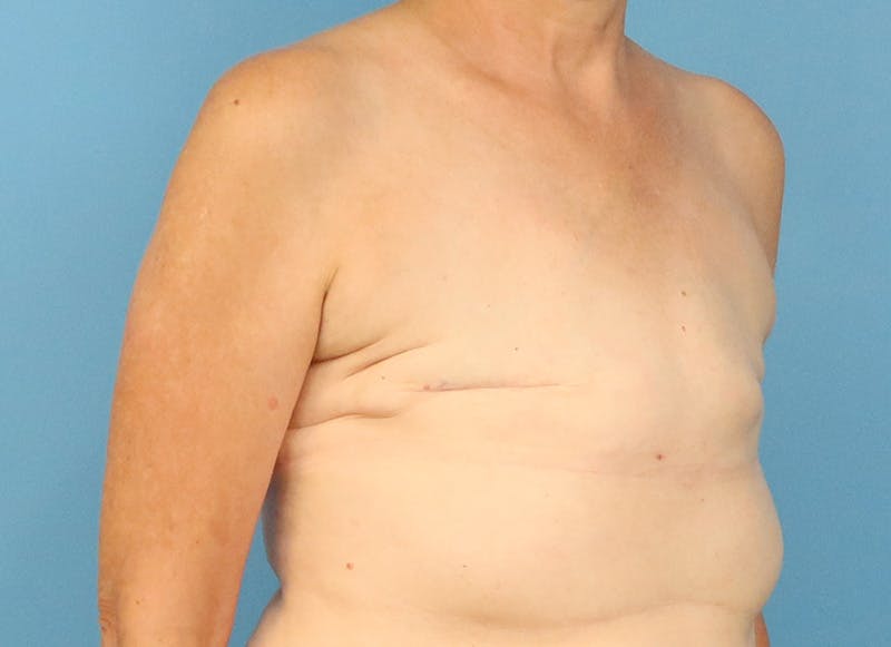 Flap Reconstruction Gallery Before & After Gallery - Patient 255284 - Image 7