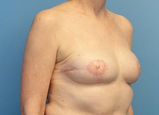 Flap Reconstruction Gallery Before & After Gallery - Patient 255284 - Image 8