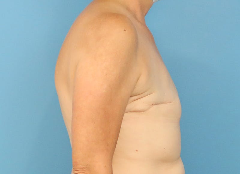 Flap Reconstruction Gallery Before & After Gallery - Patient 255284 - Image 9