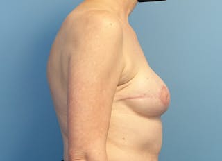 Flap Reconstruction Gallery Before & After Gallery - Patient 255284 - Image 10