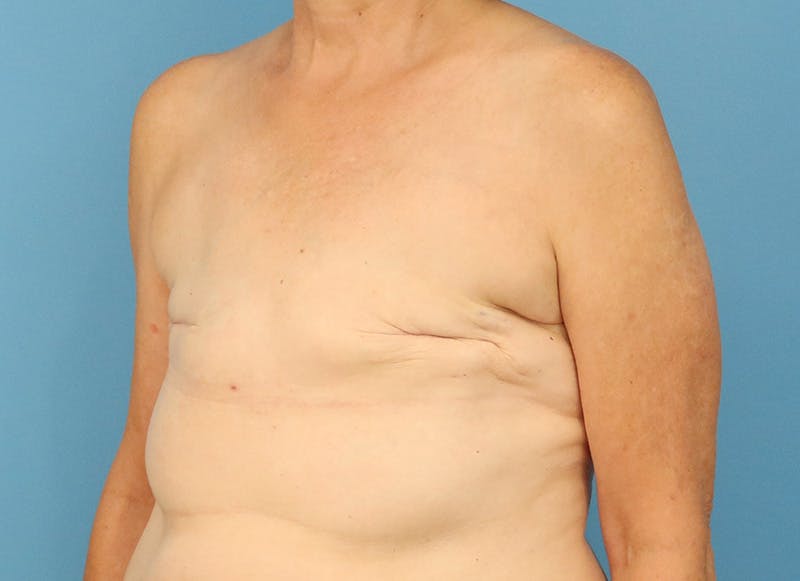 Flap Reconstruction Gallery Before & After Gallery - Patient 255284 - Image 3