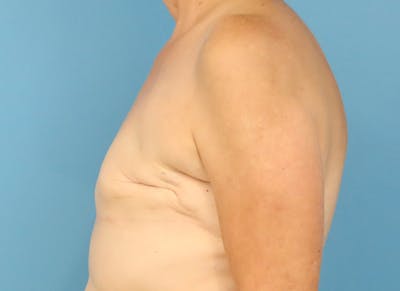 Flap Reconstruction Gallery Before & After Gallery - Patient 255284 - Image 1