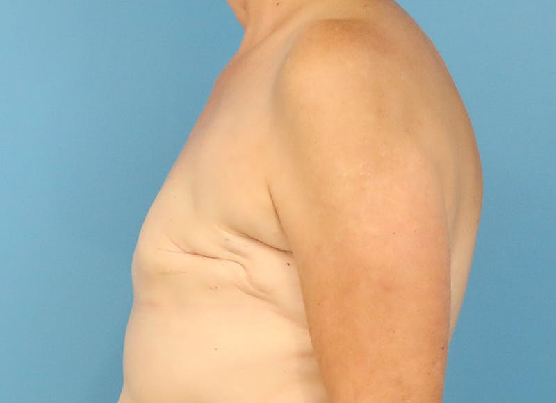 Flap Reconstruction Gallery Before & After Gallery - Patient 255284 - Image 1