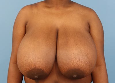 Breast Reduction Before & After Gallery - Patient 366075 - Image 5