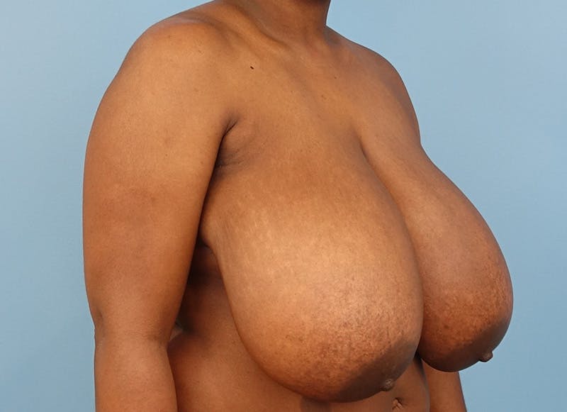 Breast Reduction Before & After Gallery - Patient 366075 - Image 7