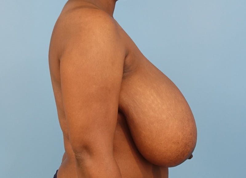 Breast Reduction Before & After Gallery - Patient 366075 - Image 9