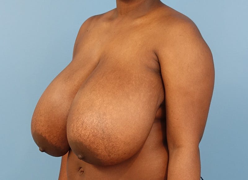 Breast Reduction Before & After Gallery - Patient 366075 - Image 3
