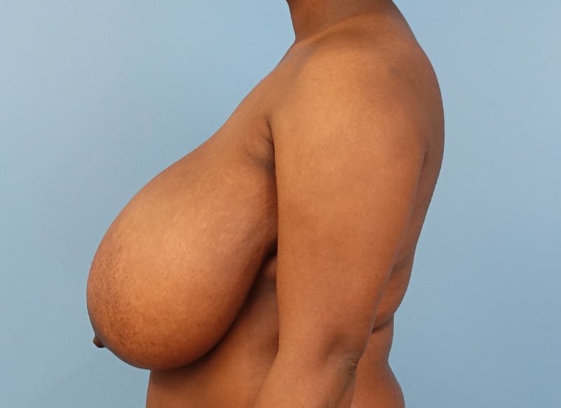 Breast Reduction Before & After Gallery - Patient 366075 - Image 1