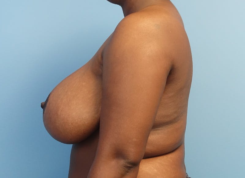 Breast Reduction Before & After Gallery - Patient 366075 - Image 2