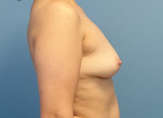 Implant Removal Before & After Gallery - Patient 339233 - Image 10