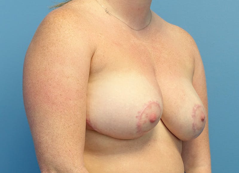 Breast Reduction Before & After Gallery - Patient 305376 - Image 8