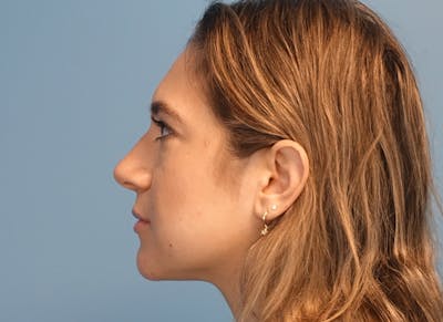 Rhinoplasty Before & After Gallery - Patient 203259 - Image 1