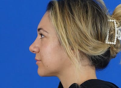 Rhinoplasty Before & After Gallery - Patient 203259 - Image 2