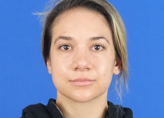 Rhinoplasty Before & After Gallery - Patient 203259 - Image 6