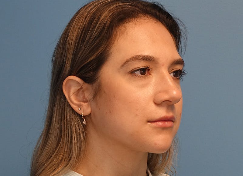 Rhinoplasty Before & After Gallery - Patient 203259 - Image 7