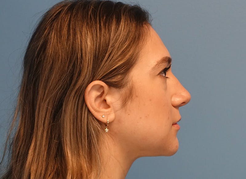 Rhinoplasty Before & After Gallery - Patient 203259 - Image 9