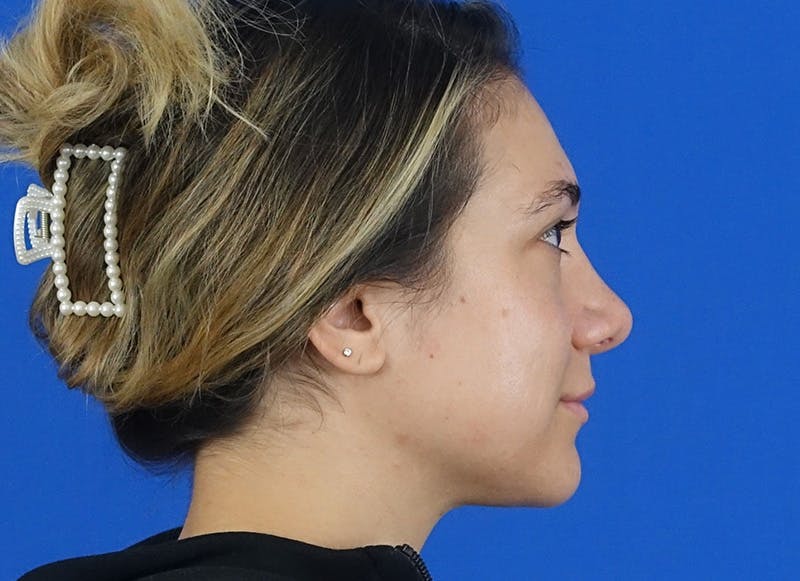Rhinoplasty Before & After Gallery - Patient 203259 - Image 10