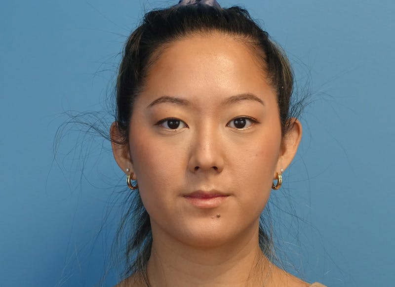 Rhinoplasty Before & After Gallery - Patient 241315 - Image 5