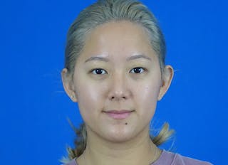 Rhinoplasty Before & After Gallery - Patient 241315 - Image 6