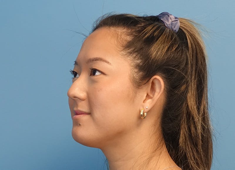 Rhinoplasty Before & After Gallery - Patient 241315 - Image 3