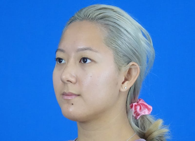 Rhinoplasty Before & After Gallery - Patient 241315 - Image 4