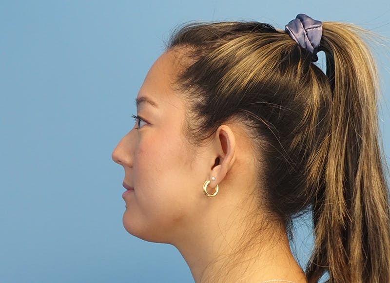 Rhinoplasty Before & After Gallery - Patient 241315 - Image 1