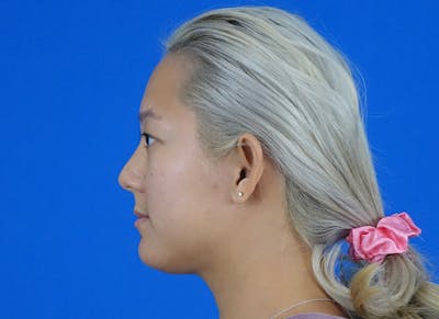 Rhinoplasty Before & After Gallery - Patient 241315 - Image 2