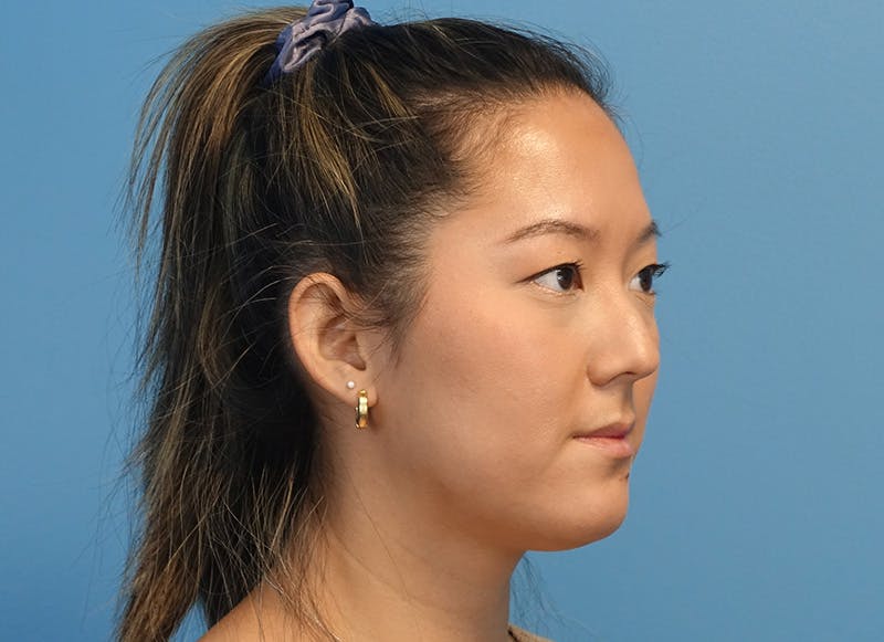 Rhinoplasty Before & After Gallery - Patient 241315 - Image 7