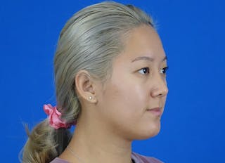 Rhinoplasty Before & After Gallery - Patient 241315 - Image 8