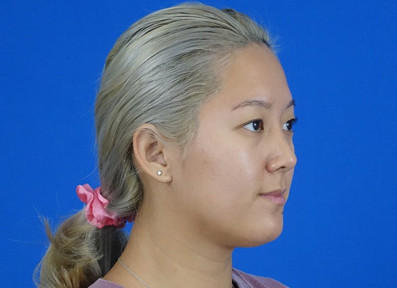 Rhinoplasty Before & After Gallery - Patient 241315 - Image 8