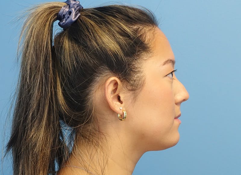 Rhinoplasty Before & After Gallery - Patient 241315 - Image 9