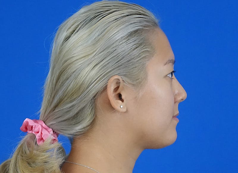 Rhinoplasty Before & After Gallery - Patient 241315 - Image 10
