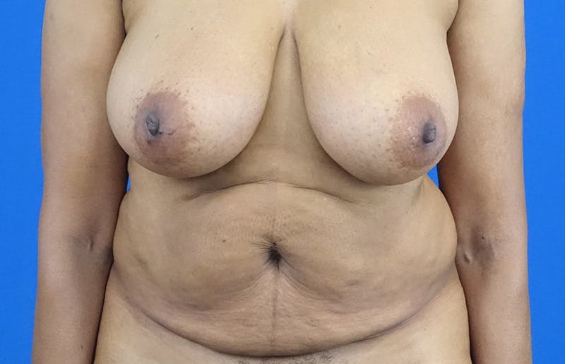Abdominoplasty Before & After Gallery - Patient 880304 - Image 5