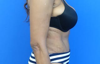 Abdominoplasty Before & After Gallery - Patient 880304 - Image 10