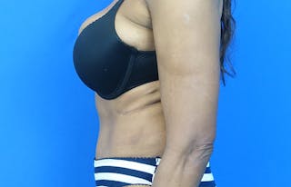 Abdominoplasty Before & After Gallery - Patient 880304 - Image 2