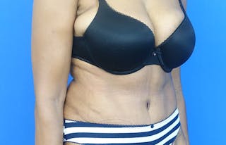Abdominoplasty Before & After Gallery - Patient 880304 - Image 8