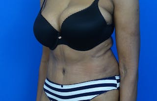 Abdominoplasty Before & After Gallery - Patient 880304 - Image 4