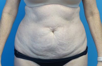 Abdominoplasty Before & After Gallery - Patient 424577 - Image 5