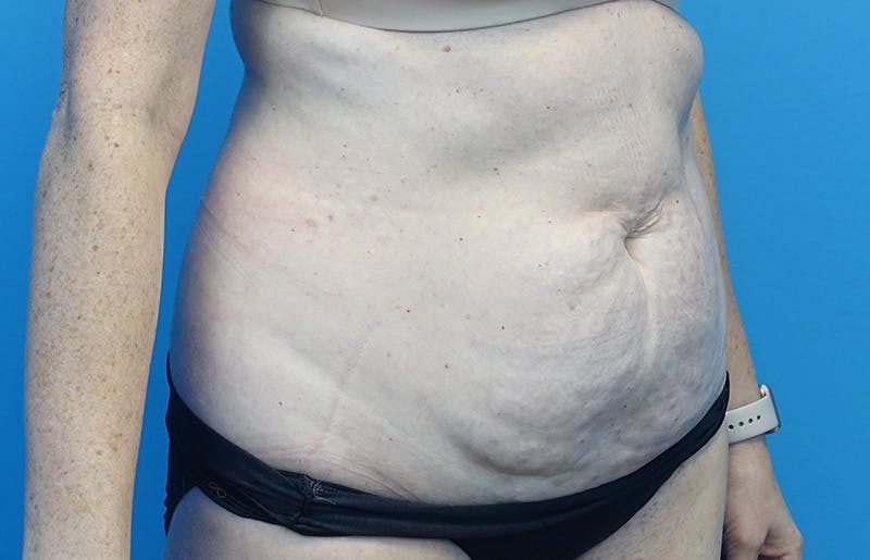 Abdominoplasty Before & After Gallery - Patient 424577 - Image 7