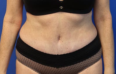 Abdominoplasty Before & After Gallery - Patient 424577 - Image 6