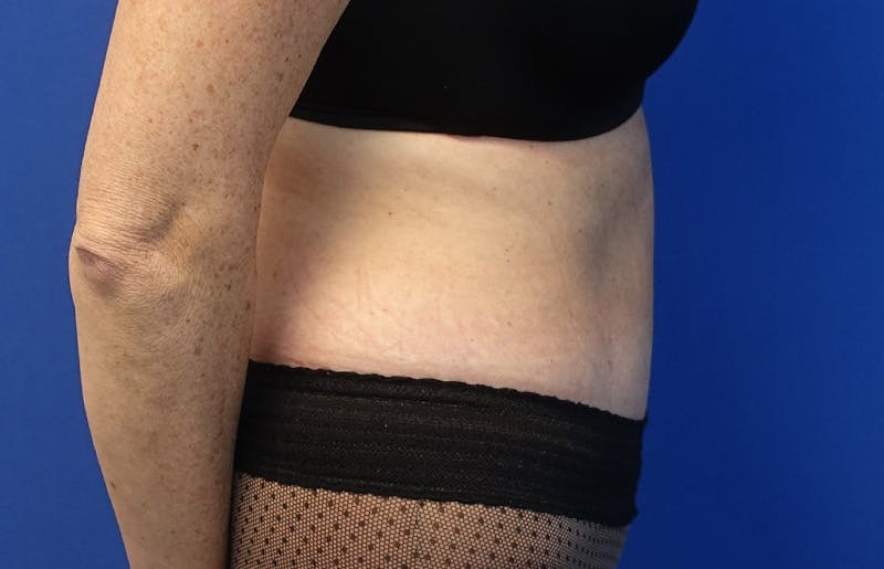 Abdominoplasty Before & After Gallery - Patient 424577 - Image 10
