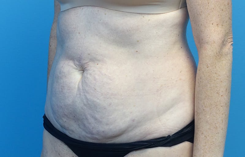 Abdominoplasty Before & After Gallery - Patient 424577 - Image 3