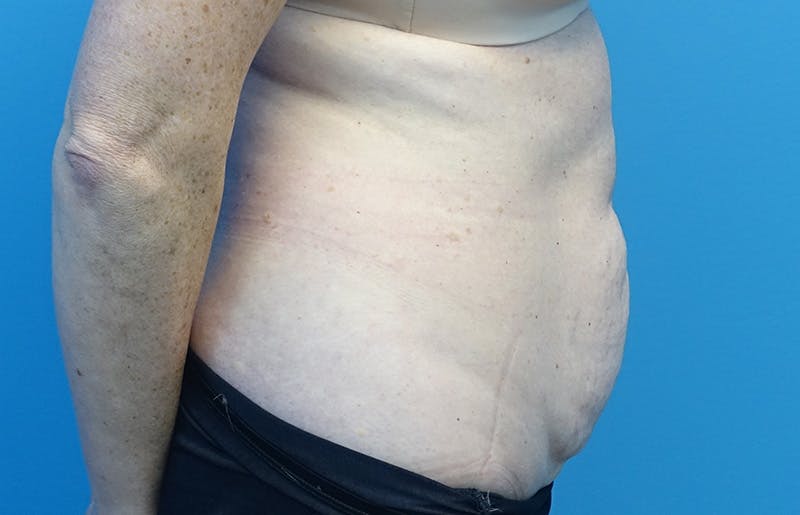 Abdominoplasty Before & After Gallery - Patient 424577 - Image 9