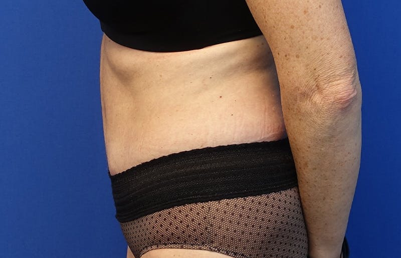 Abdominoplasty Before & After Gallery - Patient 424577 - Image 2