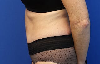 Abdominoplasty Before & After Gallery - Patient 424577 - Image 2