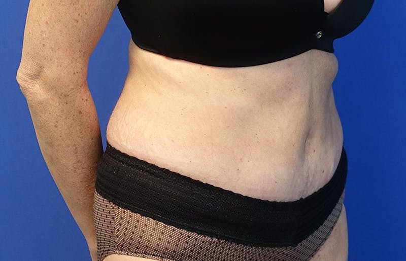 Abdominoplasty Before & After Gallery - Patient 424577 - Image 8