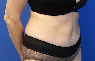 Abdominoplasty Before & After Gallery - Patient 424577 - Image 8